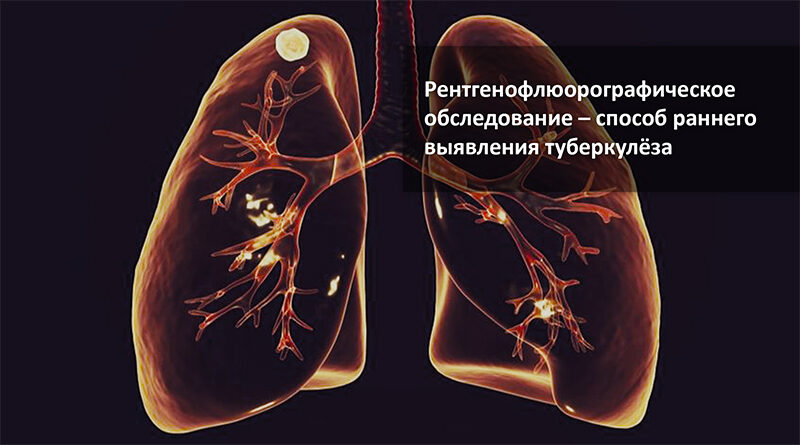 туберкулёз лёгких
